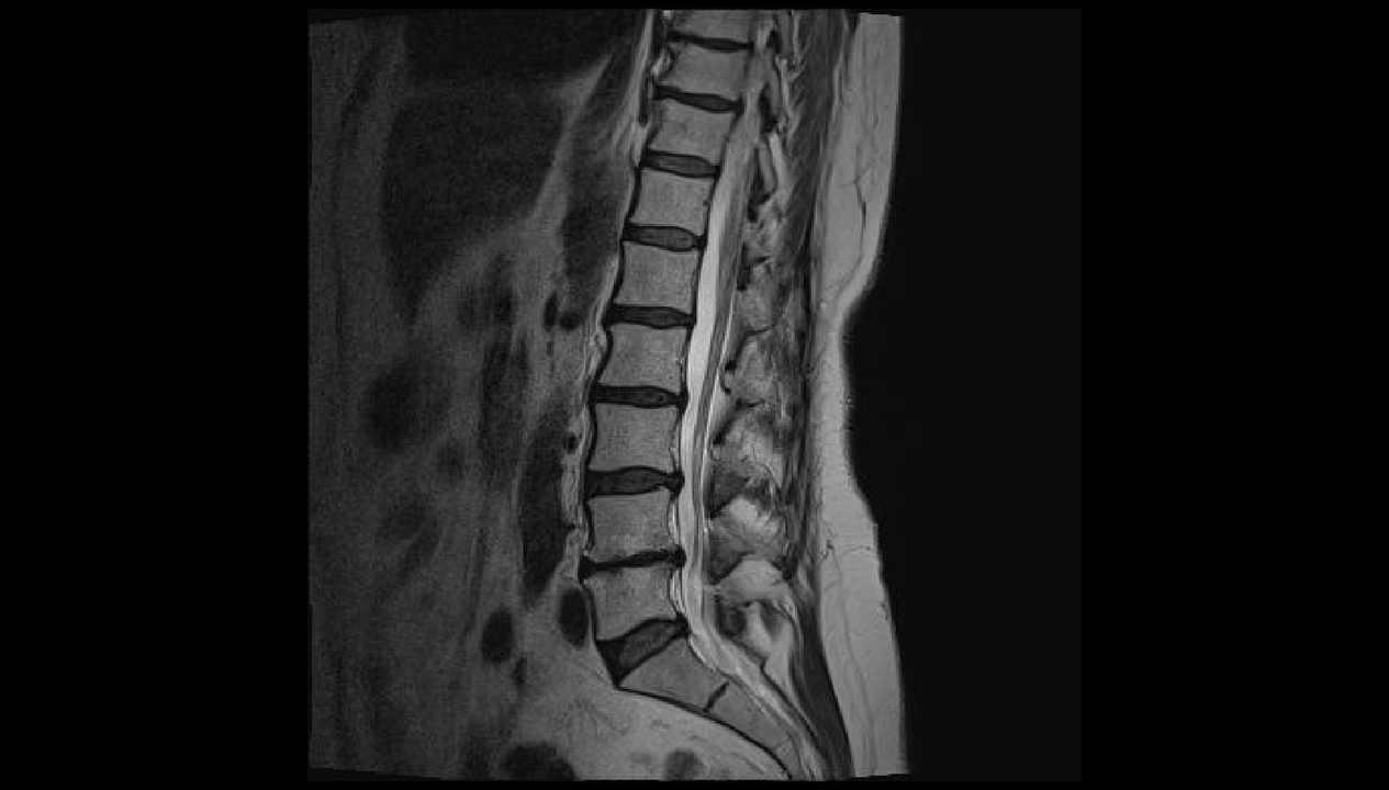 hátfájás diagnosztizálása az ágyéki régióban