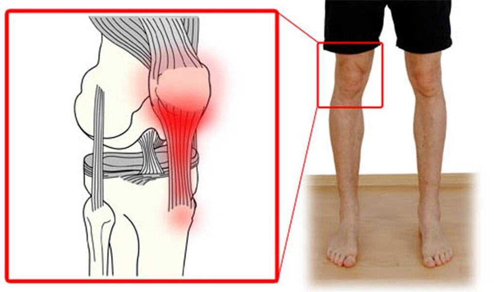 Tendinitis - az inak gyulladása a térdízületben