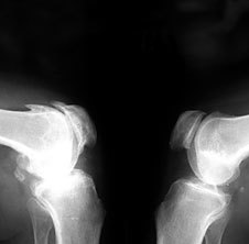 Osteoarthritis az x-ray