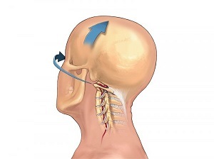 hogyan nyilvánul meg a nyaki gerinc osteochondrosis