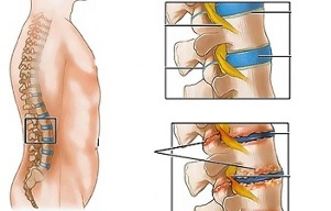 az ágyéki gerinc osteochondrosisának okai