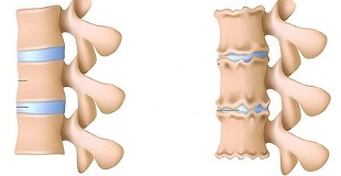 hogyan lehet felismerni az ágyéki gerinc osteochondrosisának jelenlétét