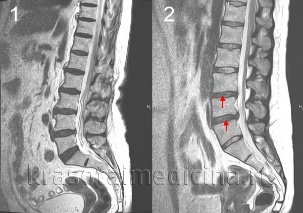 osteochondrosis a gerinc