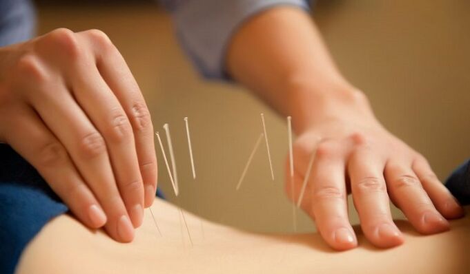 akupunktúra a derékfájás kezelésére